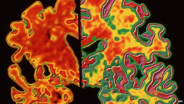_77561719_m1080332-alzheimer_s_brain-spl.jpg