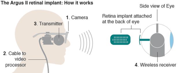 _93070347_bionic_eye_624.png