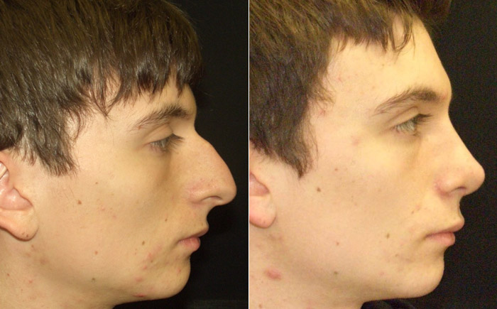 Do you have a Jewish/Arab Nose ? | Siasat.pk Forums