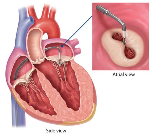 mitraclip-diagram.jpg