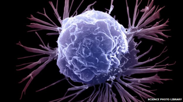 _80221275_breastcancer_spl624.jpg