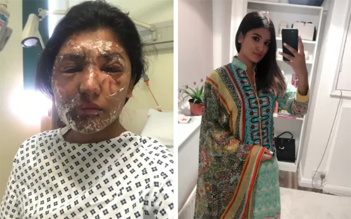 acid-attack-recovery1.jpg