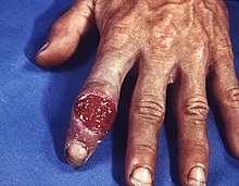 220px-Extragenital_syphilitic_chancre_of_the_left_index_finger_PHIL_4147_lores.jpg