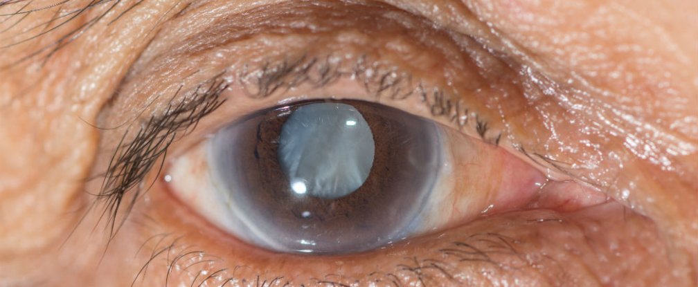 eye-cataract_1024.jpg